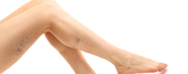 Bacaklarda Kılcal Varislerin Tedavisi